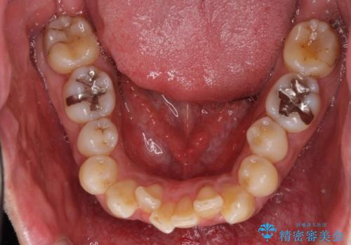 下顎骨が顕著に右側にずれている インビザラインによる咬合改善の治療前