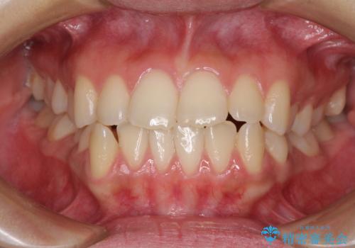 上顎骨拡大を用いたインビザラインによる非抜歯矯正の症例 治療前