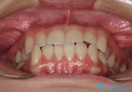 上顎骨拡大を用いたインビザラインによる非抜歯矯正の治療前