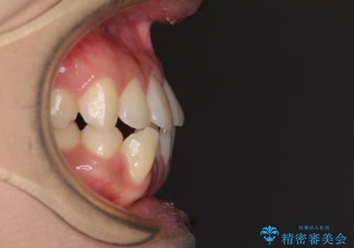 上顎骨拡大を用いたインビザラインによる非抜歯矯正の治療前