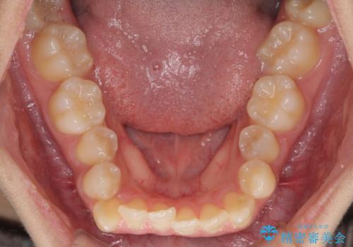 上顎骨拡大を用いたインビザラインによる非抜歯矯正の治療前