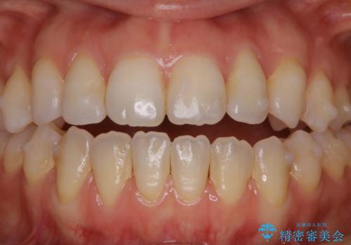 マウスピース矯正中にもPMTCで綺麗な歯を維持の症例 治療前