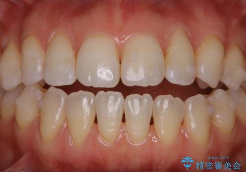 マウスピース矯正中にもPMTCで綺麗な歯を維持の症例 治療後