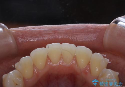 マウスピース矯正中にもPMTCで綺麗な歯を維持の治療後