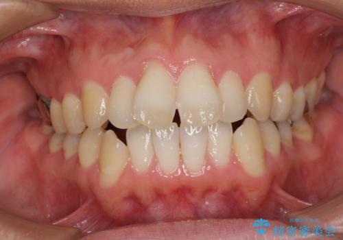 咬み合わせが気になる　ワイヤー矯正による咬み合わせ改善と奥歯のセラミック治療の症例 治療前