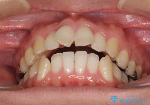 咬み合わせが気になる　ワイヤー矯正による咬み合わせ改善と奥歯のセラミック治療の治療前