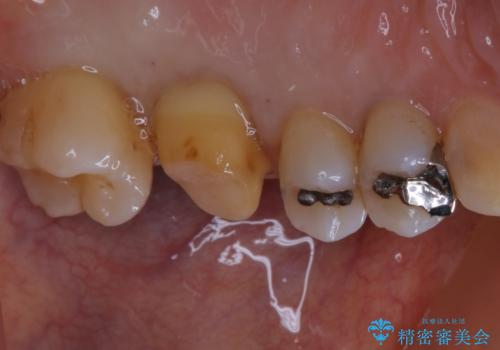 大きな詰め物を被せ物に変えて、歯の破折リスクを減らすの治療中