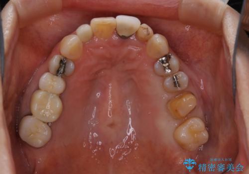 大きな詰め物を被せ物に変えて、歯の破折リスクを減らすの治療中
