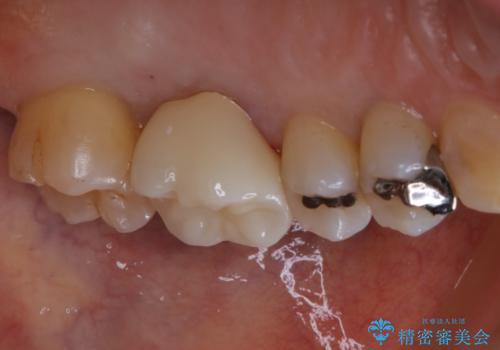 大きな詰め物を被せ物に変えて、歯の破折リスクを減らすの症例 治療後