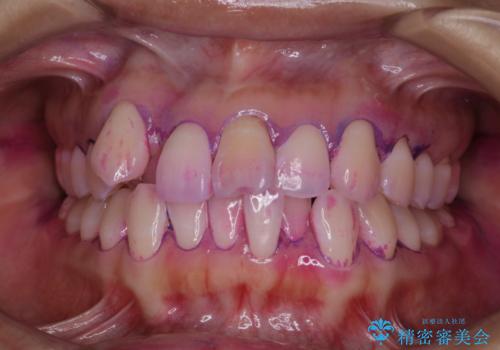 矯正治療が始まる前にクリーニングと歯磨き指導の治療前