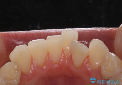 矯正治療が始まる前にクリーニングと歯磨き指導の治療後