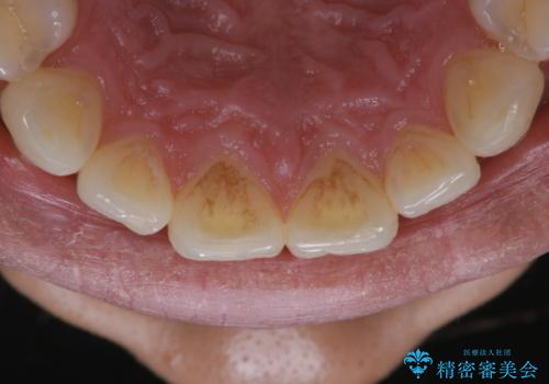 喫煙による着色をPMTCで白い歯にの治療前
