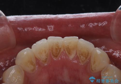 喫煙による着色をPMTCで白い歯にの治療前