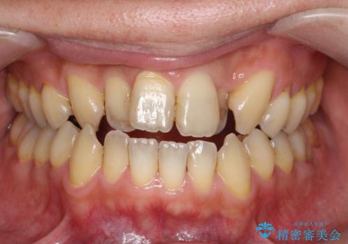 オフィスホワイトニング スペシャルコースの症例 治療前