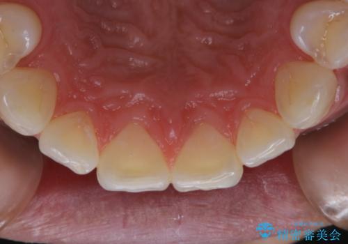 喫煙による着色をPMTCで白い歯にの治療後