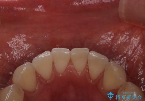 喫煙による着色をPMTCで白い歯にの治療後