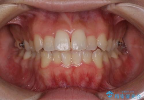 オープンバイト(開咬)を非抜歯インビザラインで治すの治療中