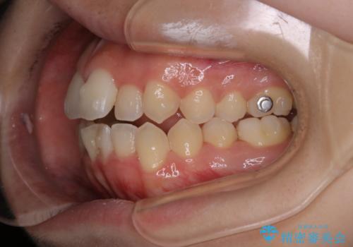 オープンバイト(開咬)を非抜歯インビザラインで治すの治療前