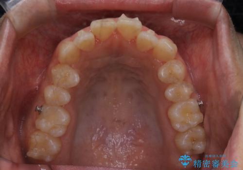 オープンバイト(開咬)を非抜歯インビザラインで治すの治療中