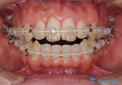 咬み合わせが気になる　ワイヤー矯正による咬み合わせ改善と奥歯のセラミック治療の治療中
