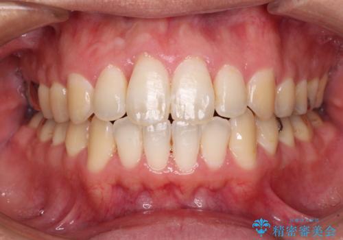 咬み合わせが気になる　ワイヤー矯正による咬み合わせ改善と奥歯のセラミック治療