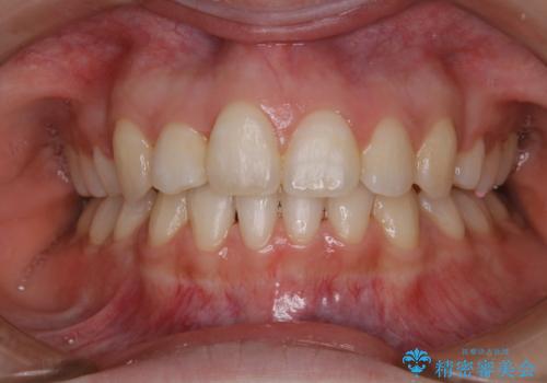 ホワイトニング　1日で真っ白な歯にの症例 治療前