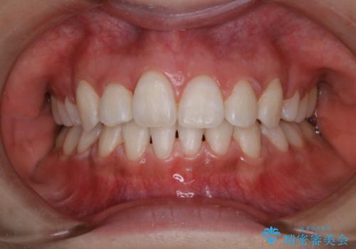 ホワイトニング　1日で真っ白な歯にの症例 治療後