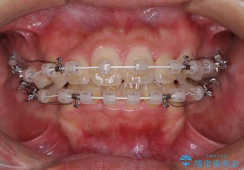 気になる八重歯を治したい 目立たないワイヤーでの抜歯矯正の治療中