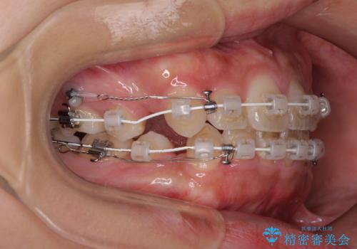気になる八重歯を治したい 目立たないワイヤーでの抜歯矯正の治療中