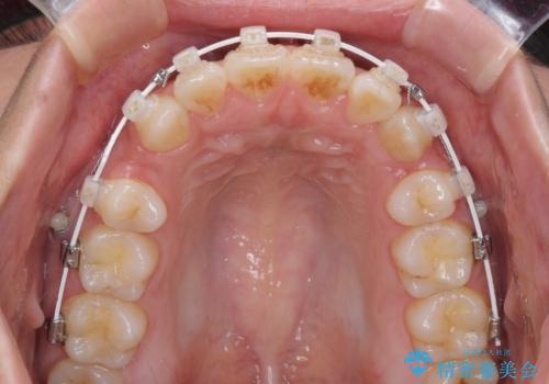気になる八重歯を治したい 目立たないワイヤーでの抜歯矯正の治療中