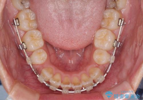 気になる八重歯を治したい　目立たないワイヤーでの抜歯矯正の治療中