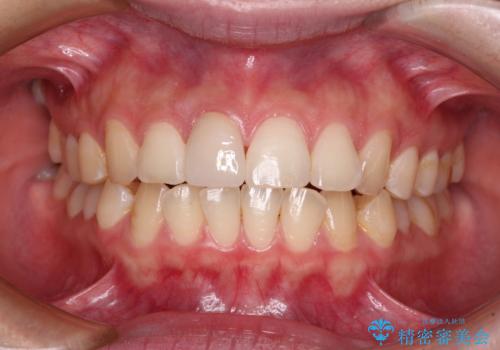 転倒して欠けてしまった前歯をオールセラミッククラウンで自然な口元にの治療後