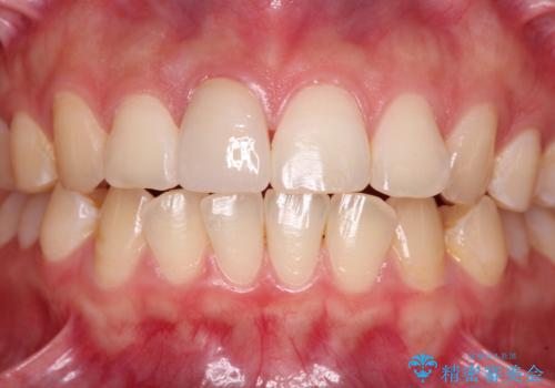 転倒して欠けてしまった前歯をオールセラミッククラウンで自然な口元にの治療後