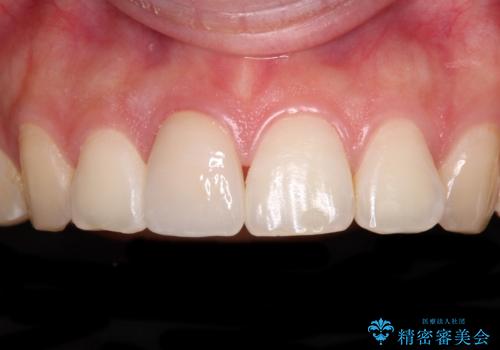 転倒して欠けてしまった前歯をオールセラミッククラウンで自然な口元にの症例 治療後