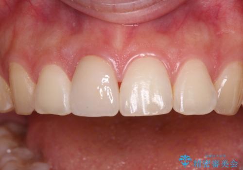 転倒して欠けてしまった前歯をオールセラミッククラウンで自然な口元にの治療後