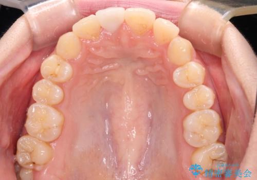 転倒して欠けてしまった前歯をオールセラミッククラウンで自然な口元にの治療後