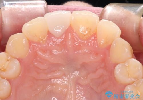 転倒して欠けてしまった前歯をオールセラミッククラウンで自然な口元にの治療後