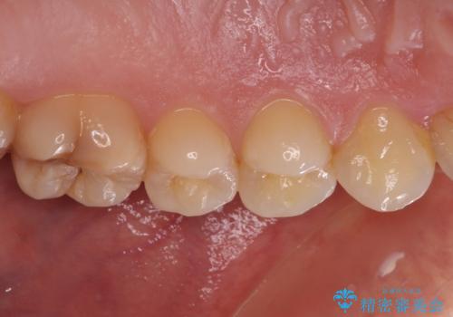 食事をするときに痛む 根管治療とセラミック補綴治療の治療前