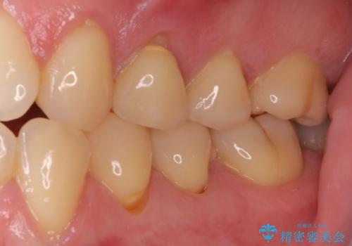 食事をするときに痛む 根管治療とセラミック補綴治療の治療前