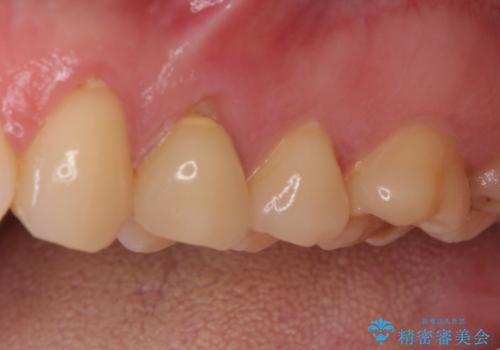 食事をするときに痛む 根管治療とセラミック補綴治療の治療前