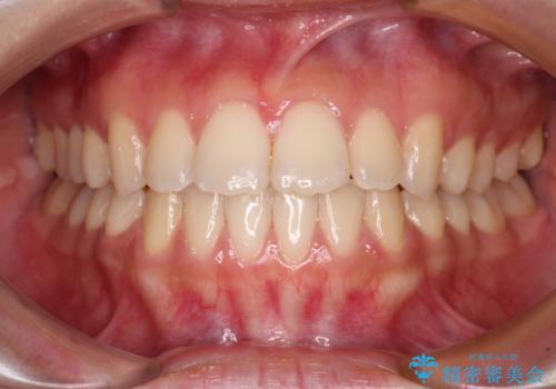 上顎骨拡大を用いたインビザラインによる非抜歯矯正の症例 治療後