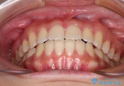 上顎骨拡大を用いたインビザラインによる非抜歯矯正の治療後