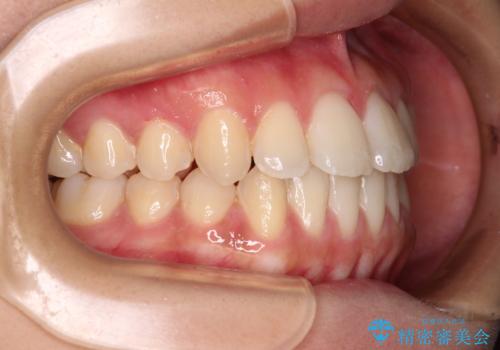 上顎骨拡大を用いたインビザラインによる非抜歯矯正の治療後
