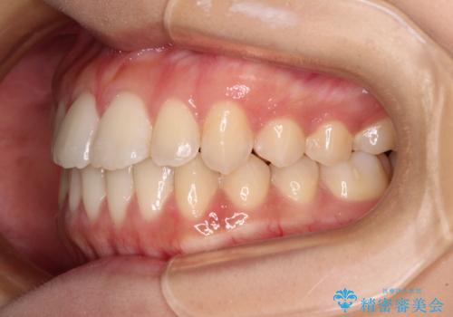 上顎骨拡大を用いたインビザラインによる非抜歯矯正の治療後
