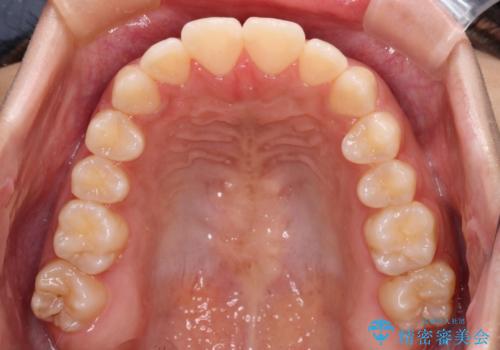 上顎骨拡大を用いたインビザラインによる非抜歯矯正の治療後