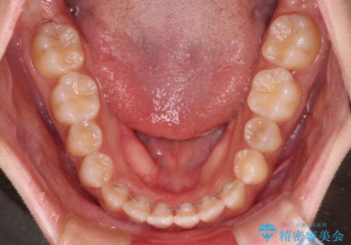 上顎骨拡大を用いたインビザラインによる非抜歯矯正の治療後