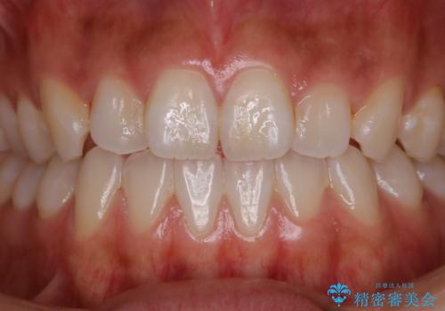 歯磨きをしてもザラつく感じをツルツルにしたいの症例 治療前