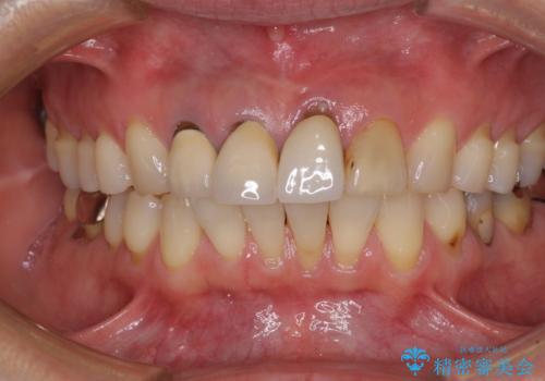抜かなければいけない前歯 歯肉移植を用いたオールセラミックブリッジの治療前