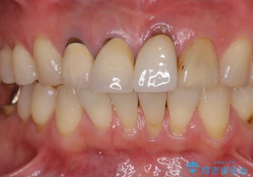 抜かなければいけない前歯 歯肉移植を用いたオールセラミックブリッジの治療前