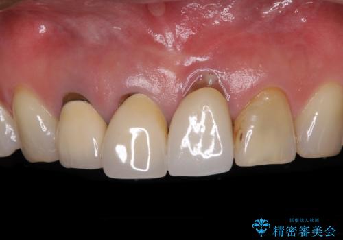 抜かなければいけない前歯 歯肉移植を用いたオールセラミックブリッジの症例 治療前